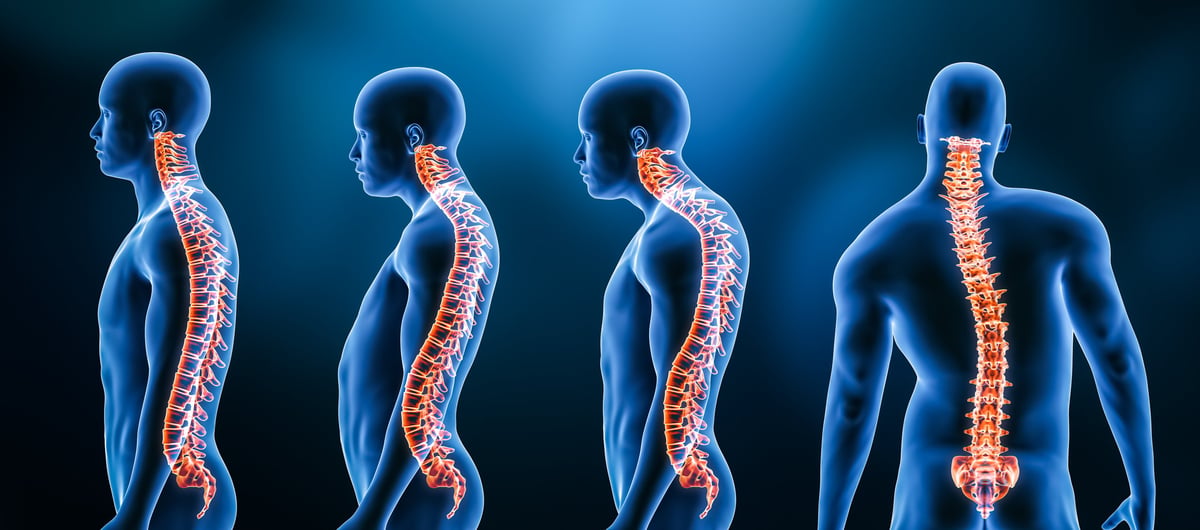 Spine curvature disorders including scoliosis (lordosis, kyphosis, scoliosis) anatomy illustration for scoliosis treatment at Texas Nerve and Spine in Sugar Land TX